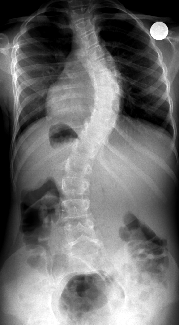 What is Scoliosis?